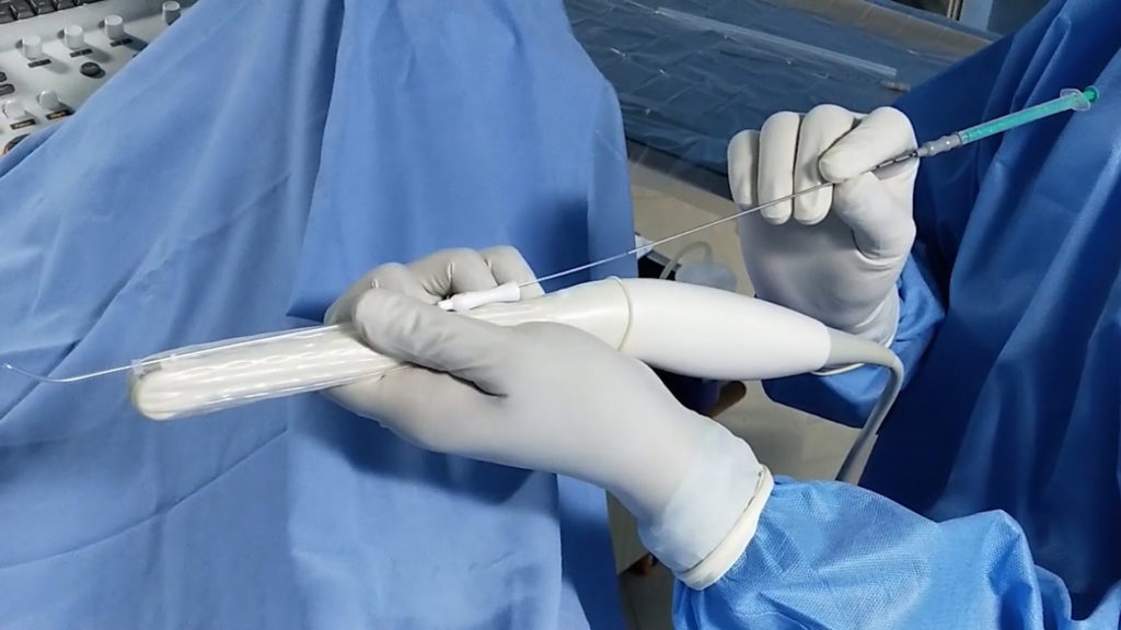 Ultrasound Guided Embryo Transfer - Krishna IVF Clinic