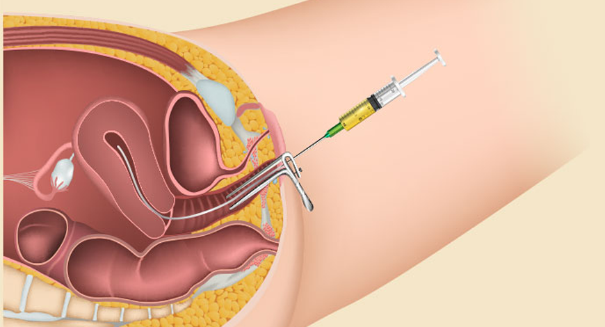 Fresh or Frozen Embryo Transfer Process Step By Step in IVF Cycle