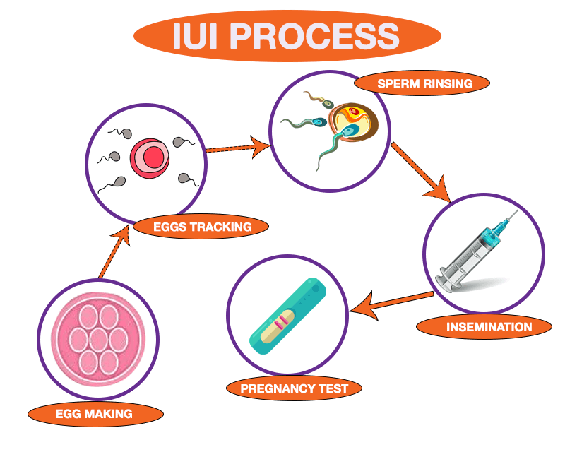 印度的 IUI 治疗程序